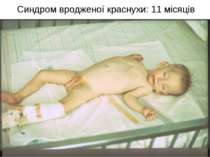 Синдром вродженої краснухи: 11 місяців