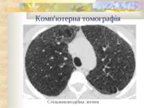 Комп'ютерна томографія Стільникоподібна легеня
