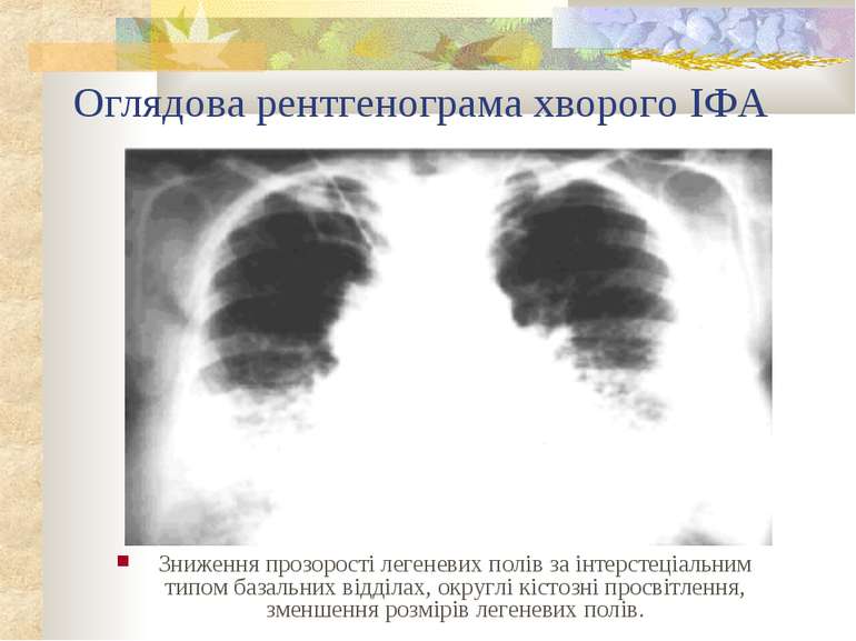 Оглядова рентгенограма хворого ІФА Зниження прозорості легеневих полів за інт...