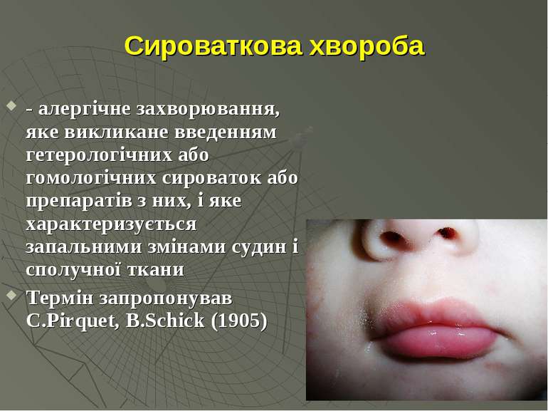 Сироваткова хвороба - алергічне захворювання, яке викликане введенням гетерол...