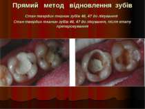 Прямий метод відновлення зубів Стан твердих тканин зубів 46, 47 до лікування ...
