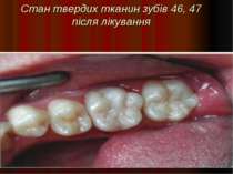 Стан твердих тканин зубів 46, 47 після лікування