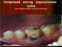 Непрямий метод відновлення зубів Стан твердих тканин зуба 36 до лікування