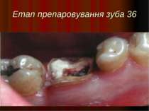 Етап препаровування зуба 36