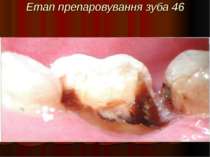 Етап препаровування зуба 46