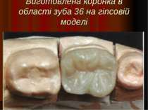 Виготовлена коронка в області зуба 36 на гіпсовій моделі