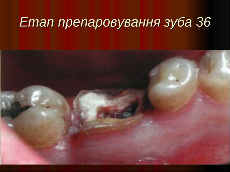 Етап препаровування зуба 36
