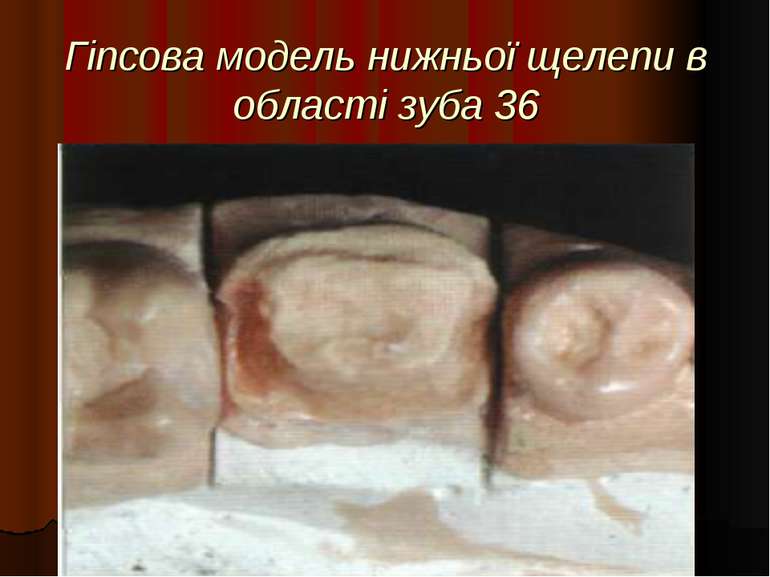 Гіпсова модель нижньої щелепи в області зуба 36
