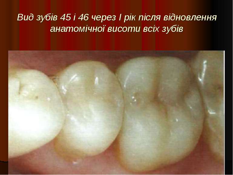 Вид зубів 45 і 46 через I рік після відновлення анатомічної висоти всіх зубів