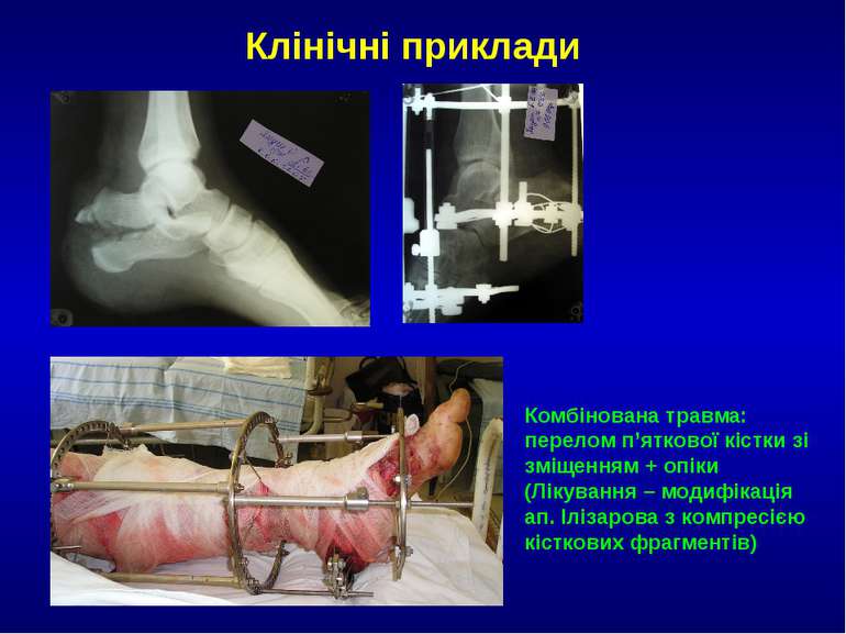 Клінічні приклади Комбінована травма: перелом п’яткової кістки зі зміщенням +...