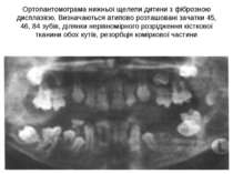 Ортопантомограма нижньої щелепи дитини з фіброзною дисплазією. Визначаються а...