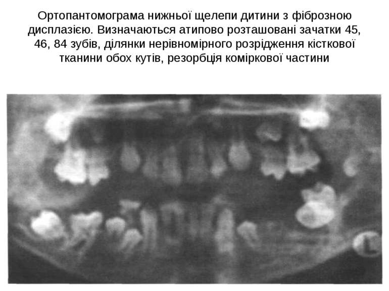 Ортопантомограма нижньої щелепи дитини з фіброзною дисплазією. Визначаються а...