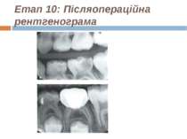 Етап 10: Післяопераційна рентгенограма