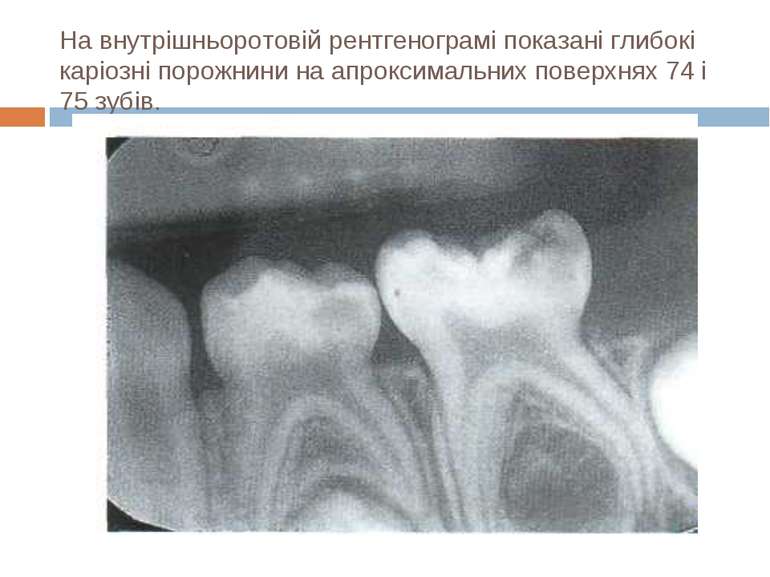 На внутрішньоротовій рентгенограмі показані глибокі каріозні порожнини на апр...