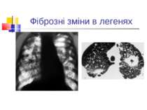 Фіброзні зміни в легенях