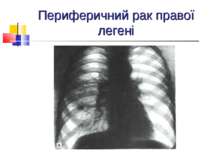 Периферичний рак правої легені