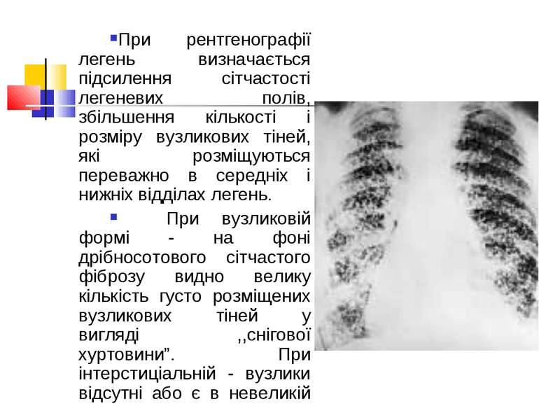 При рентгенографії легень визначається підсилення сітчастості легеневих полів...