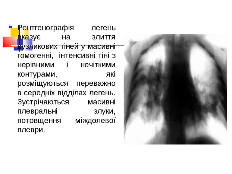 Рентгенографія легень вказує на злиття вузликових тіней у масивні гомогенні, ...