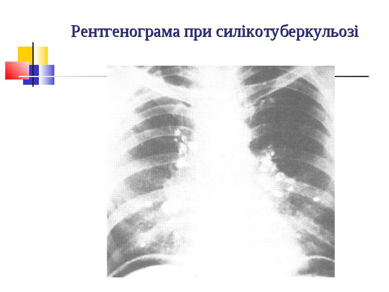 Рентгенограма при силікотуберкульозі