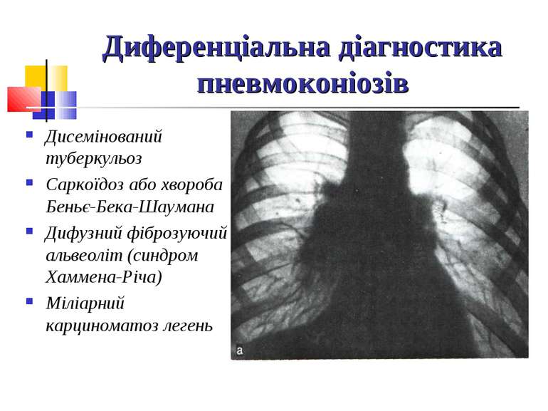 Диференціальна діагностика пневмоконіозів Дисемінований туберкульоз Саркоїдоз...