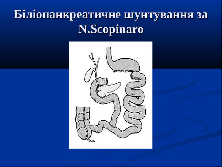 Біліопанкреатичне шунтування за N.Scopinaro