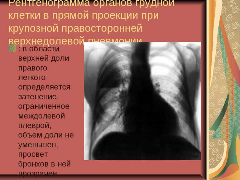 Рентгенограмма органов грудной клетки в прямой проекции при крупозной правост...