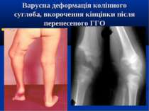 Варусна деформація колінного суглоба, вкорочення кінцівки після перенесеного ГГО