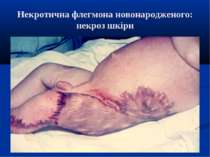 Некротична флегмона новонародженого: некроз шкіри
