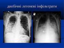 двобічні легеневі інфільтрати
