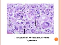 Патологічні мітози в клітинах пухлини
