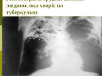 Ренгенограма грудної клітини людини, яка хворіє на туберкульоз