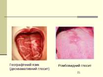 Географічний язик (десквамативний глосит) Ромбовидний глосит