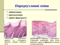 Передпухлинні зміни лейкоплакія; еритроплакія; хейліт Манганотті. Лейкоплакія...