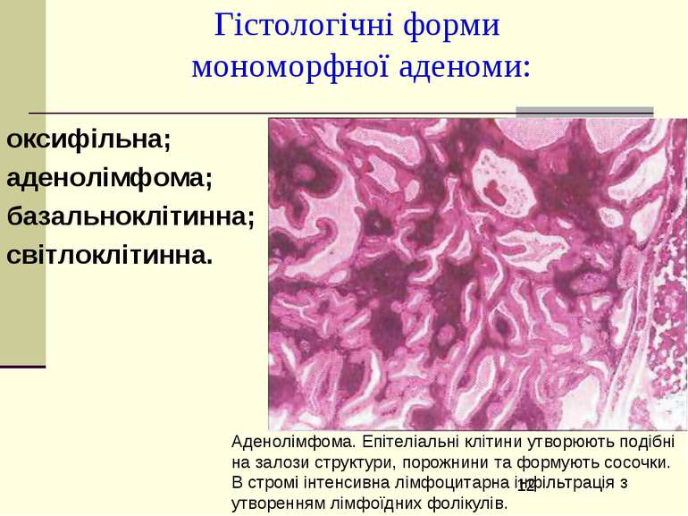 Гістологічні форми мономорфної аденоми: оксифільна; аденолімфома; базальноклі...