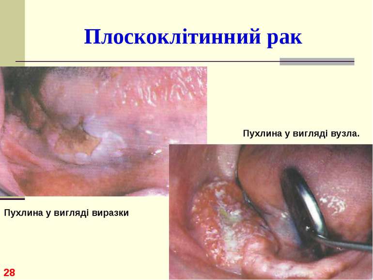 Плоскоклітинний рак * Пухлина у вигляді виразки Пухлина у вигляді вузла.