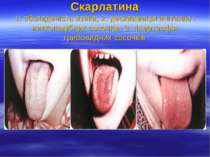 Скарлатина 1. обкладеність язика; 2. десквамація епітелію і ниткоподібних сос...