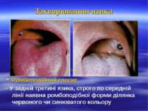 Захворювання язика Ромбоподібний глосит - У задній третині язика, строго по с...