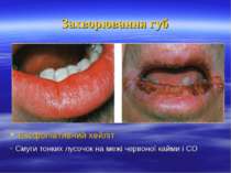 Захворювання губ Ексфоліативний хейліт - Смуги тонких лусочок на межі червоно...