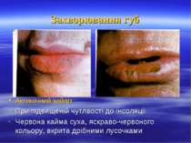 Захворювання губ Актинічний хейліт При підвищеній чутлвості до інсоляції Черв...