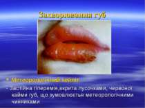 Захворювання губ Метеорологічний хейліт - Застійна гіперемія,вкрита лусочками...