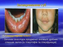 Захворювання губ Гляндулярний хейліт - Виникає внаслідок вродженої аномалії д...