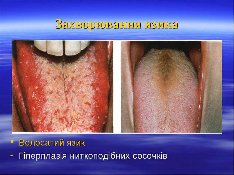 Захворювання язика Волосатий язик Гіперплазія ниткоподібних сосочків