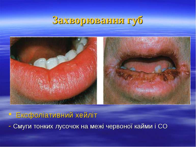 Захворювання губ Ексфоліативний хейліт - Смуги тонких лусочок на межі червоно...