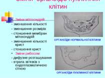 Зміни органоїдів пухлинних клітин Зміни мітохондрій: - зменшення кількості - ...