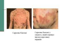 Саркома Капоші Саркома Капоші у хворого, який отримує імуносупресивну терапію