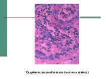 Cryptococcus neoformans (nervous system)