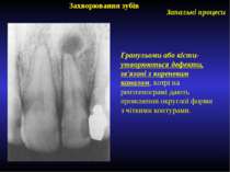 Захворювання зубів Запальні процеси Гранульоми або кісти- утворюються дефекти...