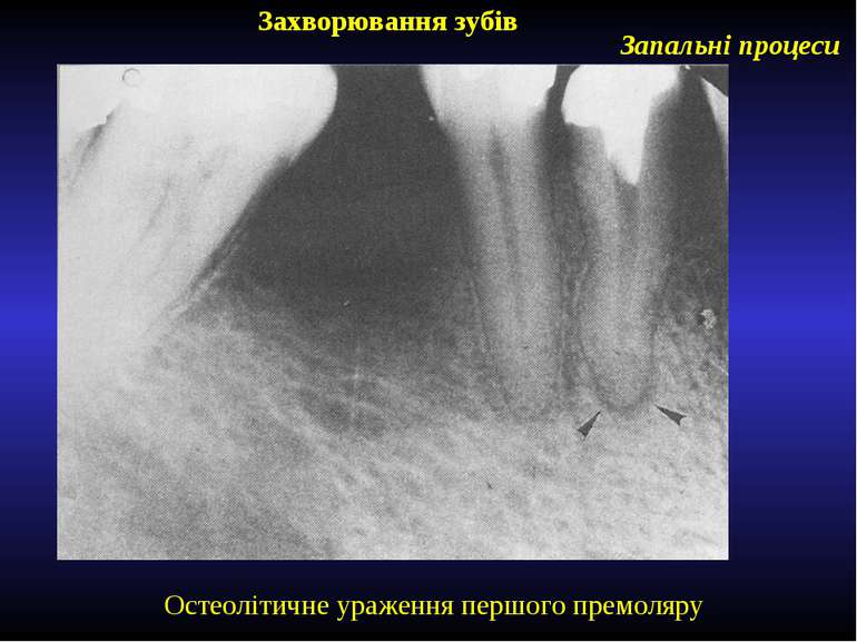 Захворювання зубів Запальні процеси Остеолітичне ураження першого премоляру