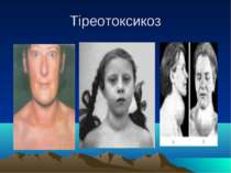 Тіреотоксикоз