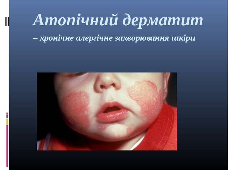 Атопічний дерматит – хронічне алергічне захворювання шкіри